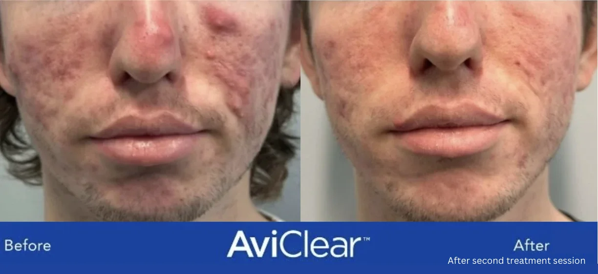 Before and After of Avi Clear Acne Treatments